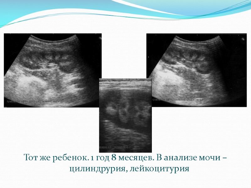 Тот же ребенок. 1 год 8 месяцев. В анализе мочи – цилиндрурия, лейкоцитурия